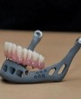 New jaw created in 3D printer